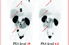 PSMA PET CT
