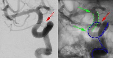 Endovascular aneurysm treatment: Coiling by stent