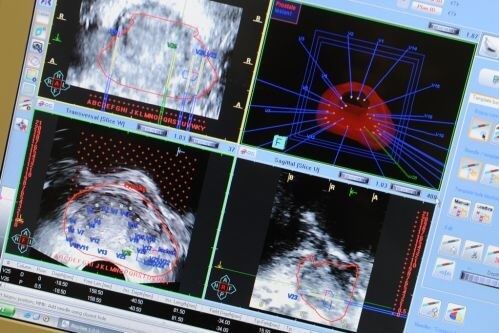 MRI guided biopsy