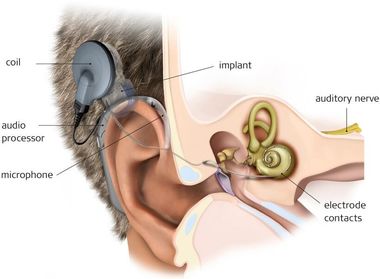 Cochlea implant